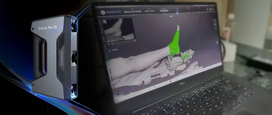 先临三维×树蚁医疗 | 广州第一人民医院借助高精度3D数字化技术精准完成横向骨搬运术