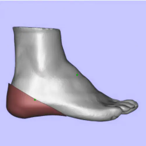 3D扫描+3D打印定制足矫形器，拯救足底筋膜炎患者