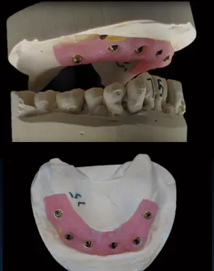 如何数字化制作上颌6-6种植排牙桥？