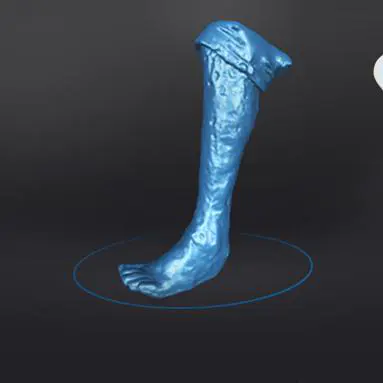 案例 | 定制足托，3D数字化技术帮助烧伤患者正常行走
