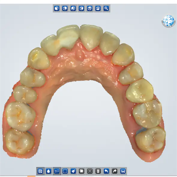优秀病例 | 数字化技术在前牙即刻种植及修复中的应用一例