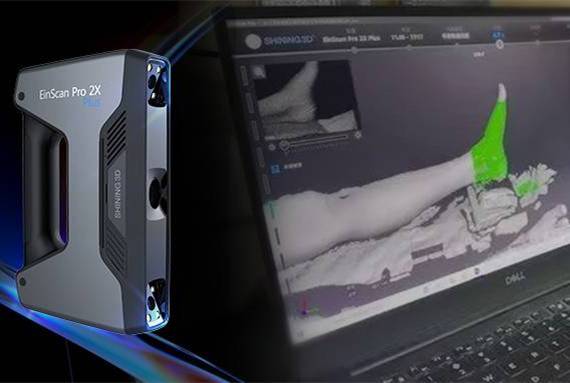 星空体育×树蚁医疗 | 广州第一人民医院借助高精度3D数字化技术精准完成横向骨搬运术